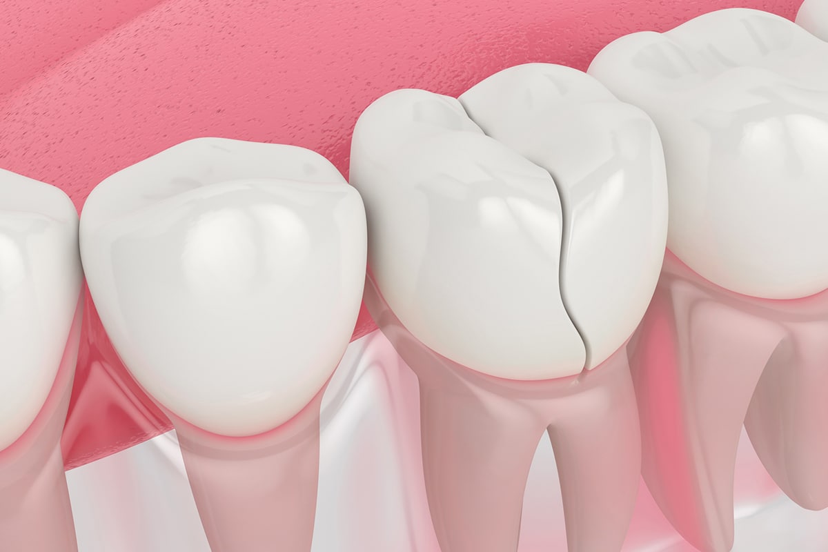 How Do Dentists Fix Cracked Teeth? Rapid City, SD