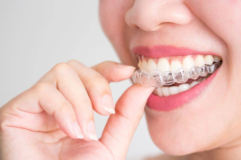 How Does Invisalign Compare to Traditional Braces?