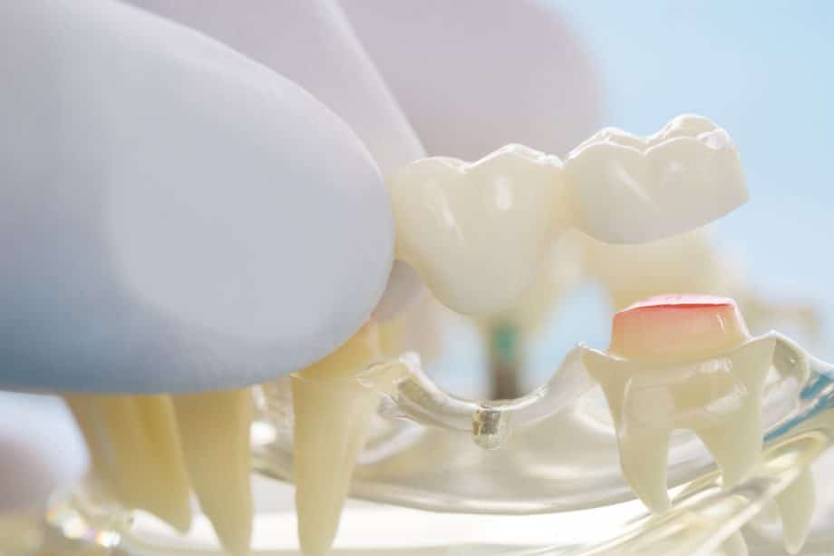 How Long Do Dental Bridges Last?