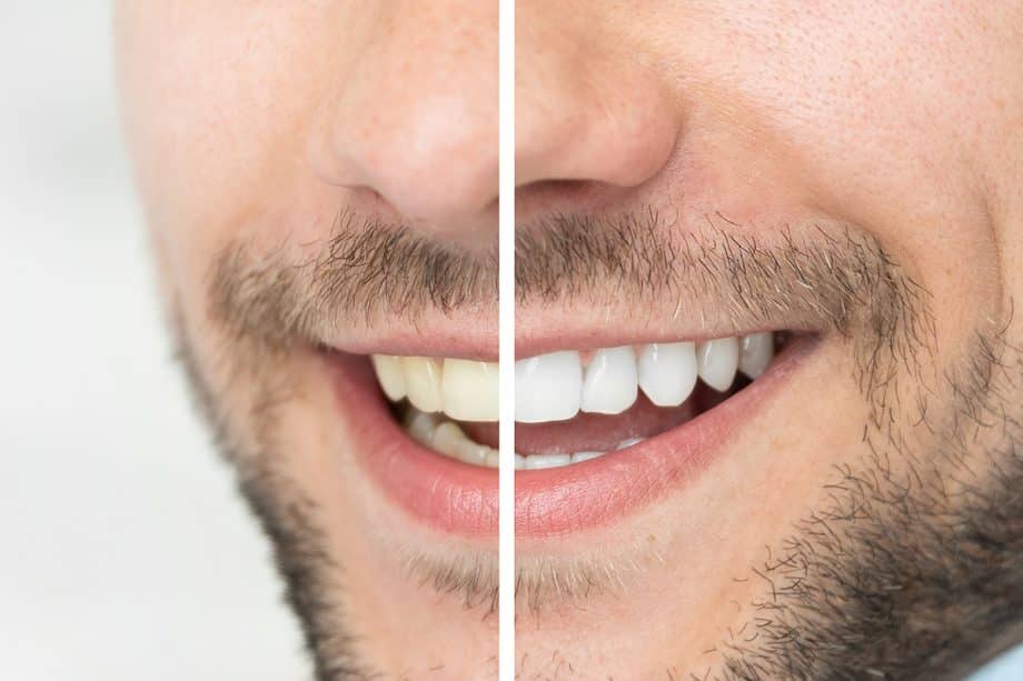 How Much Does Teeth Whitening Cost In Rapid City, SD?